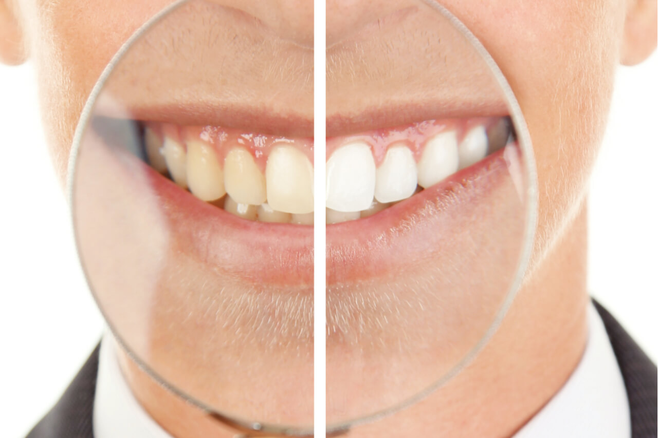 How Much Does Zoom Teeth Whitening Cost Benefits And Risks 
